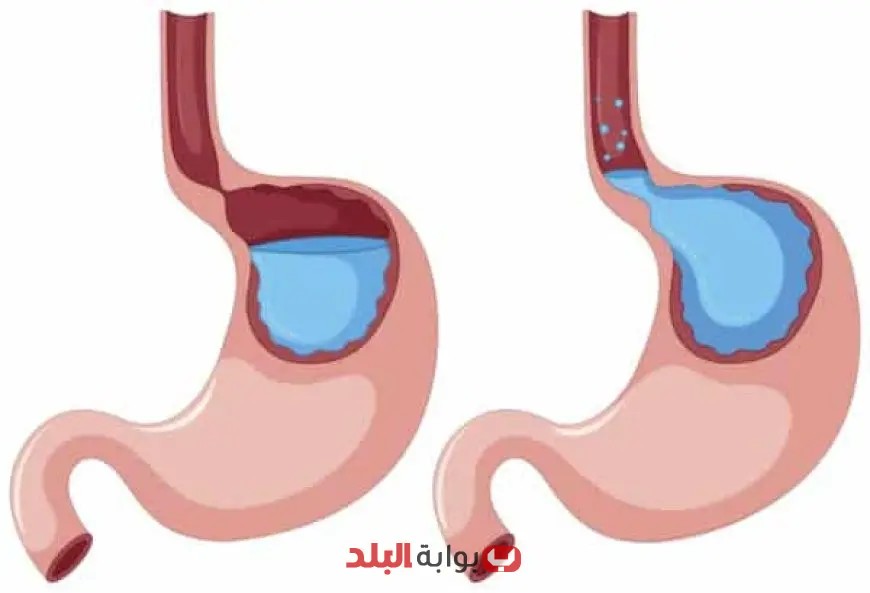 “تعرف على كيفية تأثير الشاي والقهوة على ارتجاع المريء: طبيب يفسر الأسباب الكامنة”