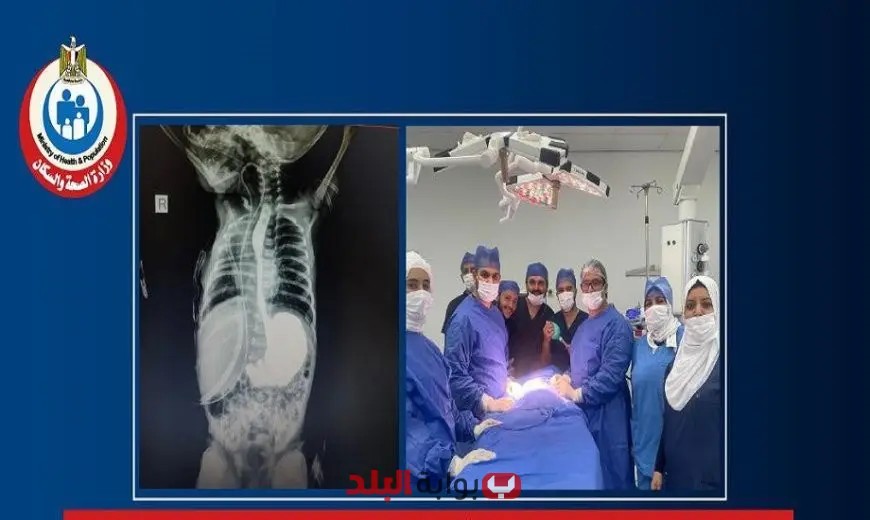 جراحة طارئة تنقذ رضيعة تبلغ من العمر 3 أيام من خطر الاختناق في مستشفى الخانكة