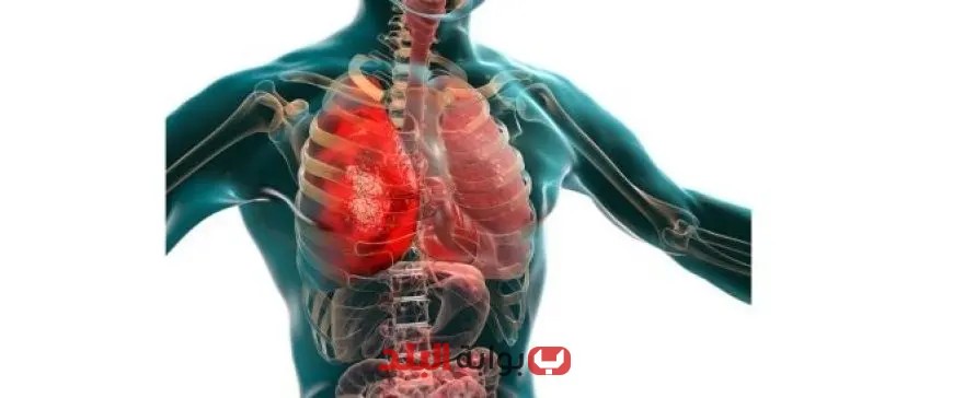 من الفيروس إلى التلف الرئوي: كيف يبدأ المرض الخفي في تدمير رئتيك؟