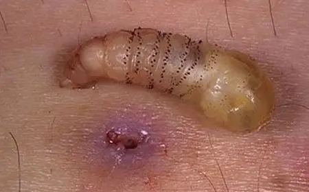 أول حالة إصابة بشرية بالدودة الحلزونية في أمريكا تثير مخاوف من انتشار المرض