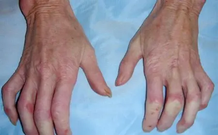 تفاصيل جديدة عن فيروس جلدي ينتشر في مدرسة بالجيزة وبيان عاجل من وزارة التعليم وإجراءات سريعة للحد منه