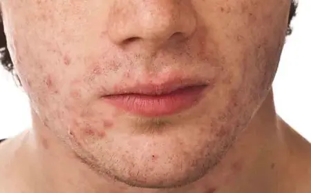 تعليم الجيزة تكشف عن 4 حالات طلاب ظهرت عليهم أعراض حبوب في اليدين