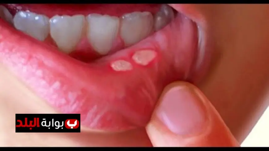 حسام موافي ينبه لمخاطر تقرحات الفم كعلامة على وجود مرض خطير