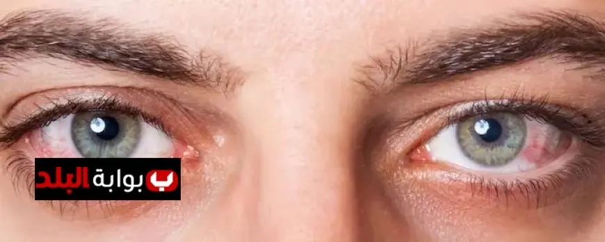 أهم مشاكل العين في الشتاء تبخر الدموع والحساسية الموسمية فيديو