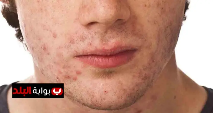 تعليم الجيزة تكشف عن 4 حالات طلاب ظهرت عليهم أعراض حبوب في اليدين